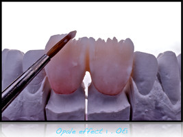 Layering of 2 anterior teeth, 11 and 21.