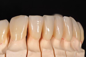 Case1: Clinical case with Dr Koubi S. / Veneers