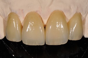 Case2: Clinical case with Dr Jeannin T. / Veneers
