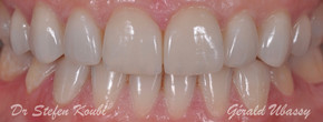 Veneers and overlays .Dr Stéfen Koubi/Gérald Ubassy