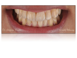 Работа 1 : Клиническая работа, реализованная с доктором Стефаном Куби / реставрация 2х  зубов на 1 импланте.