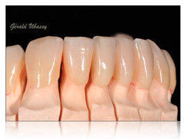 Клиническая работа, реализованная с доктором Стефаном Куби / виниры на фронтальных нижних зубах