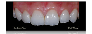 Clinical case, Dr Sidney Kina / 12 anterior veneers