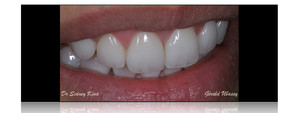 Clinical case, Dr Sidney Kina / 12 anterior veneers