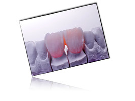 Layering of 2 anterior teeth, 11 and 21.