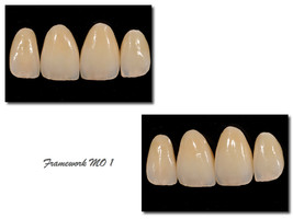 Case2: Clinical case with Dr Jeannin T. / Veneers