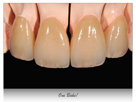 Case2: Clinical case with Dr Jeannin T. / Veneers