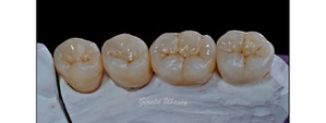 Работа 1 : Клиническая работа, реализованная с доктором Ларой Стангасилович / Жевательные зубы на адаптированном абаттменте