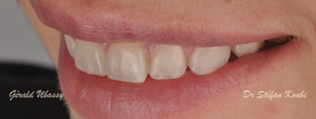 Veneers and crowns/ Dr Stéfan Koubi