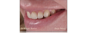 Clinical case with the  Dr Massihi Richard / 6 anterior veneers