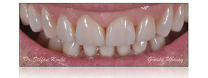 Работа 1 : Клиническая работа, реализованная с доктором Стефаном Куби / виниры и оверлей, 2 зубных ряда.