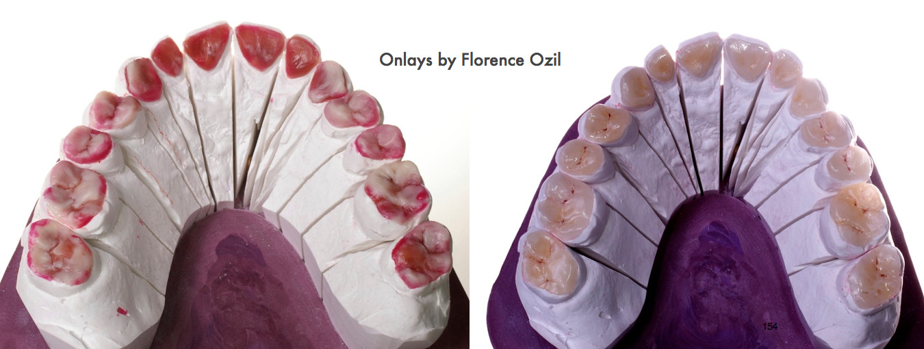 Onlay by Florence Ozil / labo Ubassy