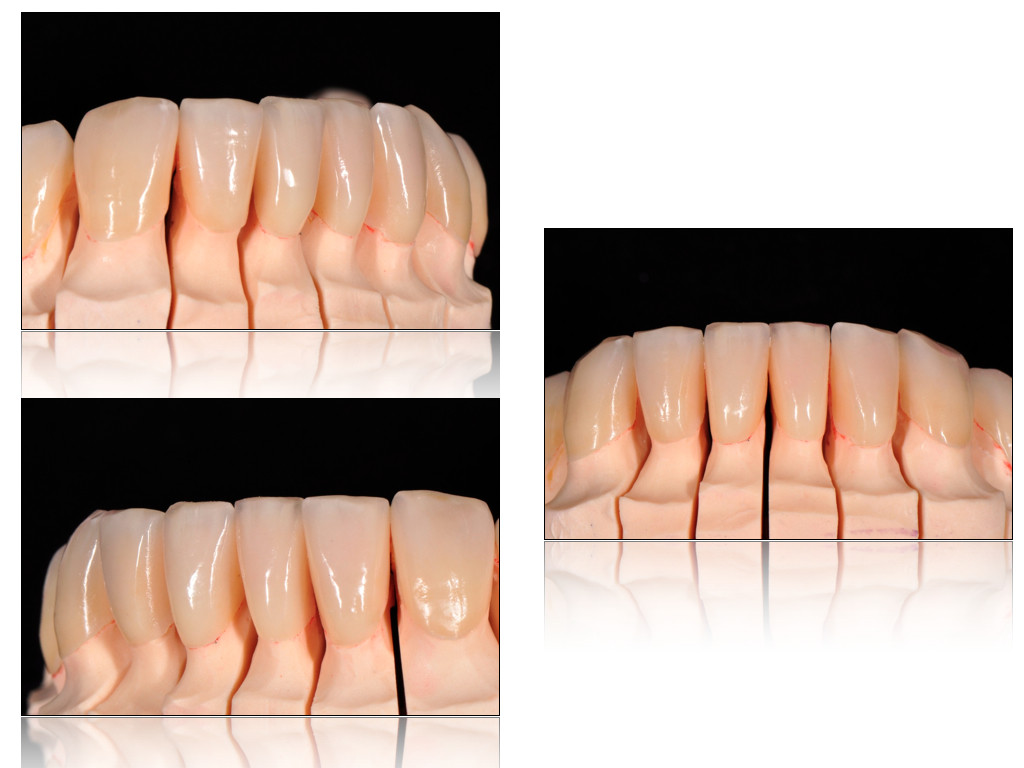 Veneers O.7 mm