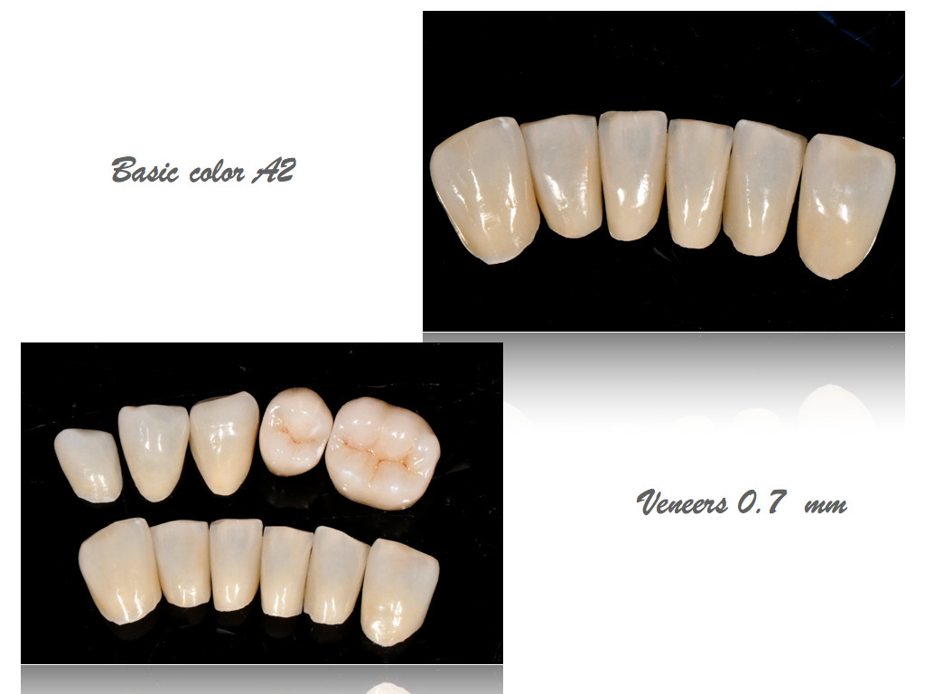 Veneers O.7 mm