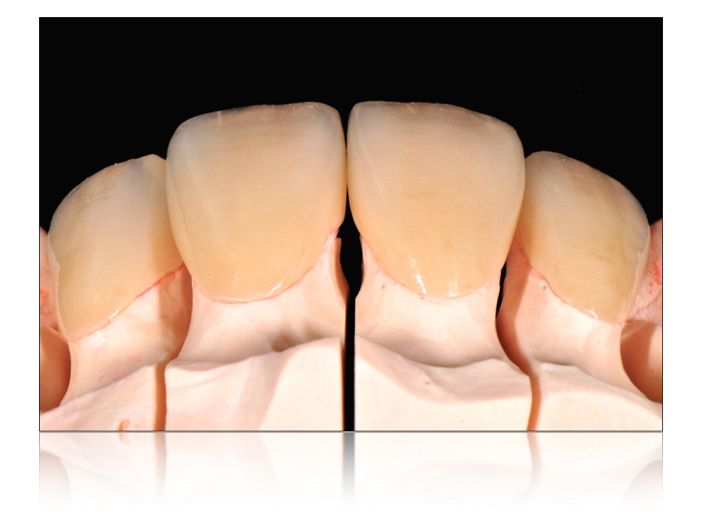 Veneers after mechanical polishing