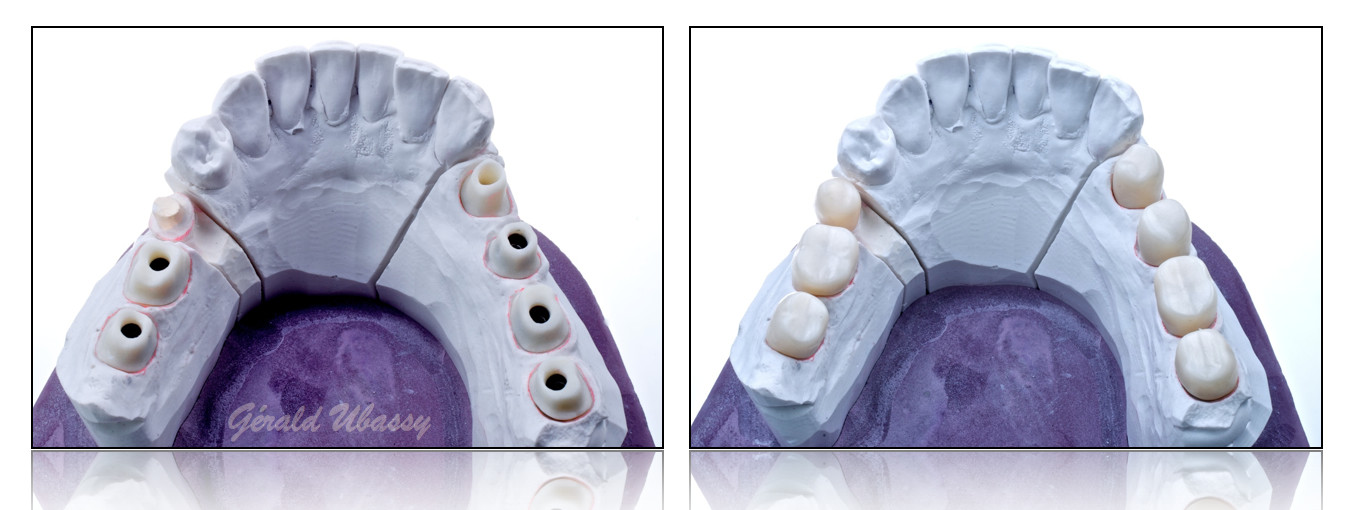 Lara-Stangacilovic-dents-postérieures