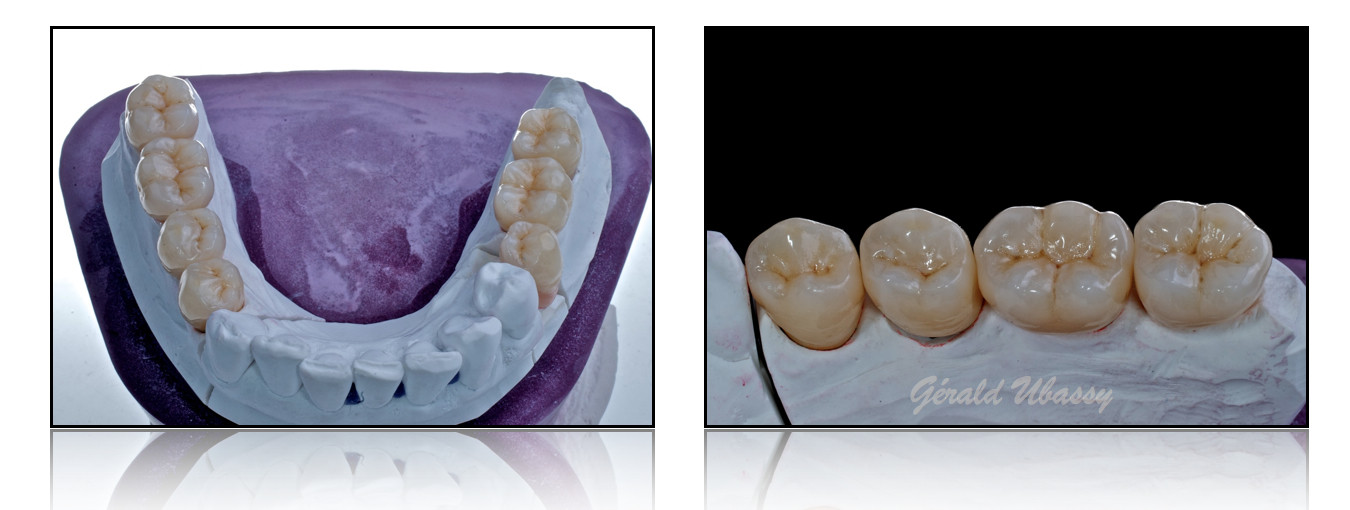 Lara-Stangacilovic-dents-postérieures