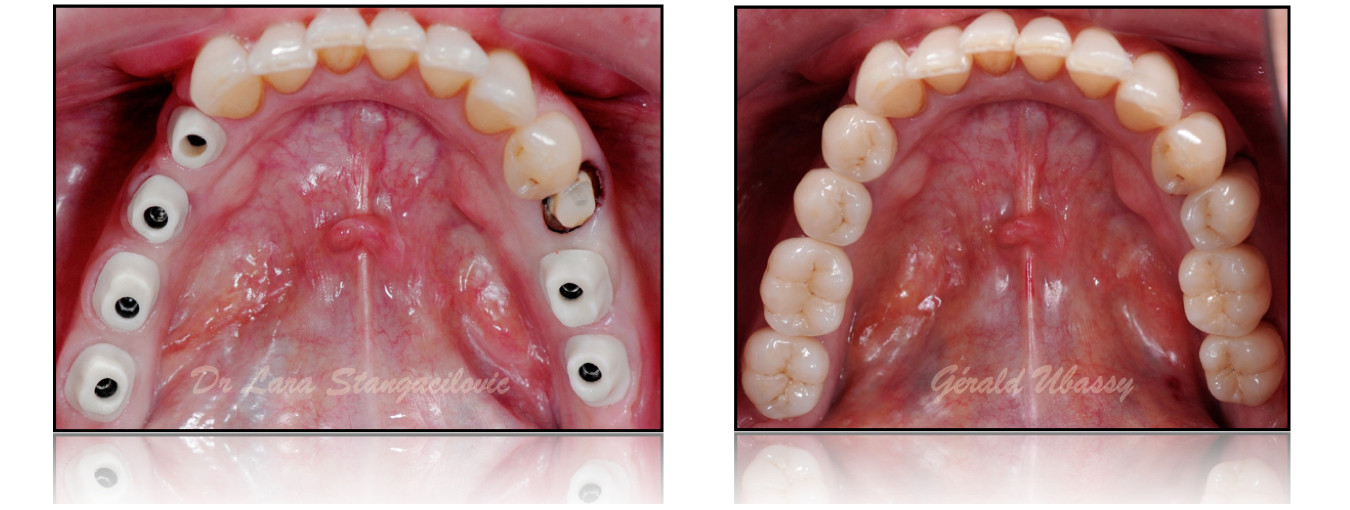 Lara-Stangacilovic-dents-postérieures